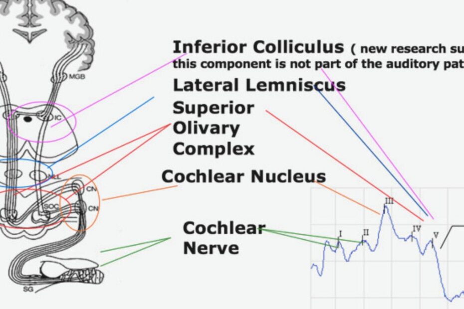 ABR Testing And How It Can Detect Hearing Loss 1 ABR Testing